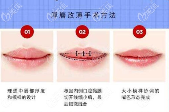 厚唇改薄手術(shù)方法和步驟 厚唇改薄手術(shù)方法和步驟