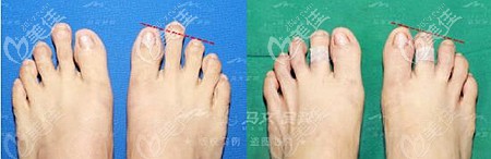 二腳趾縮短微創(chuàng)手術(shù)恢復(fù)照片 二腳趾縮短微創(chuàng)手術(shù)恢復(fù)照片
