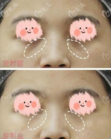 打嗨體1.5+2.5填淚溝和眼周細(xì)紋20天效果圖