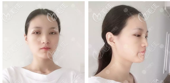 楊曉英醫(yī)生雙眼皮術(shù)后3天恢復(fù)效果