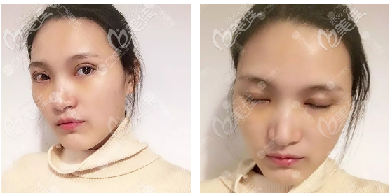 雙眼皮恢復(fù)過程7天自拍