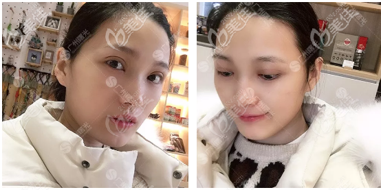 楊曉英醫(yī)生雙眼皮案例半個月反饋