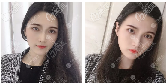 廣州曙光楊曉英醫(yī)生做雙眼皮怎么樣