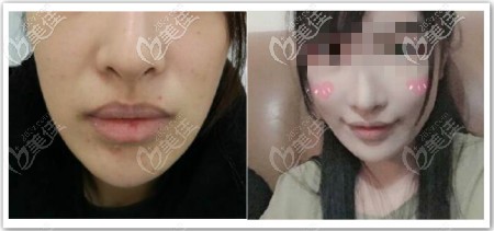 我做手術(shù)微笑唇恢復(fù)半年前后對比照 我做手術(shù)微笑唇恢復(fù)半年前后對比照