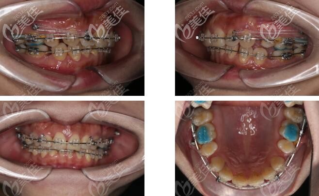 全口mbt直絲弓矯正圖片