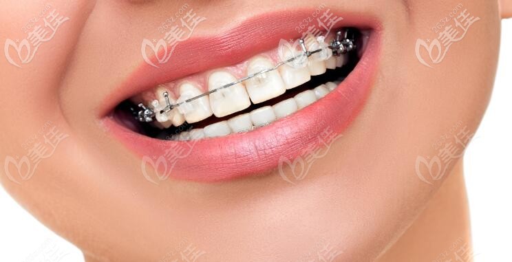 陶瓷mbt半隱形牙齒矯正圖