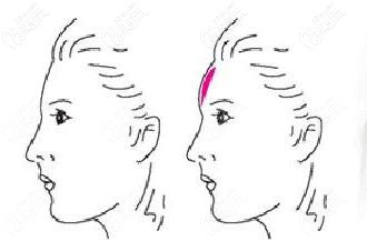 額部填充前后對(duì)比照 額部填充前后對(duì)比照