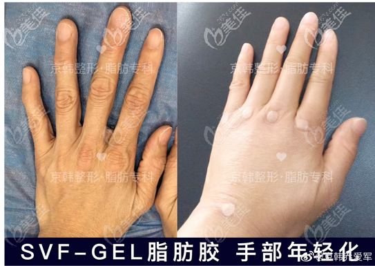 北京京韓喬愛軍脂肪膠填充手背手指案例對比圖 北京京韓喬愛軍脂肪膠填充手背手指案例對比圖