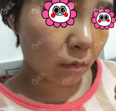 做鼻整形一周的效果照 做鼻整形一周的效果照