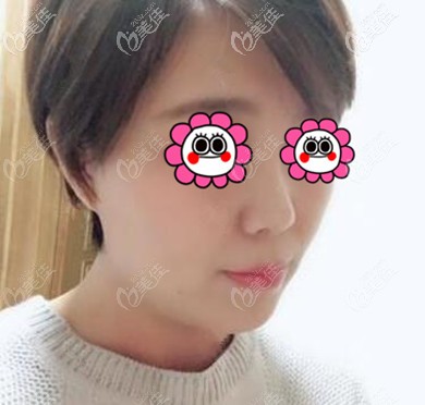 從我做耳軟骨復合隆鼻一個月的恢復過程圖來告訴你沈陽名流隆鼻技術怎么樣