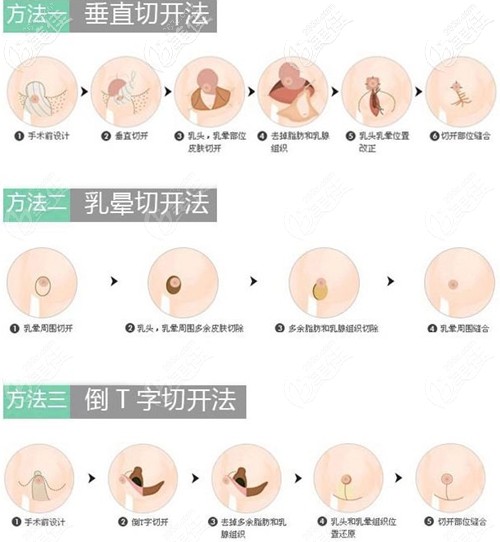 縮胸手術(shù)細(xì)節(jié) 縮胸手術(shù)細(xì)節(jié)