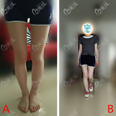 O型腿矯正案例圖