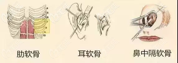 隆鼻常用的自體軟骨 隆鼻常用的自體軟骨