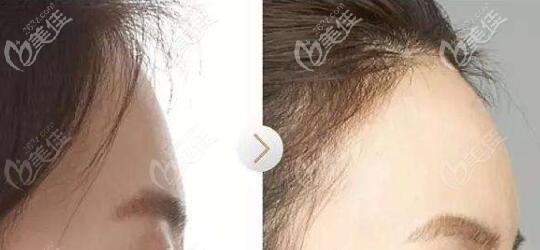 自體脂肪豐額頭真人前后對(duì)比照 自體脂肪豐額頭真人前后對(duì)比照