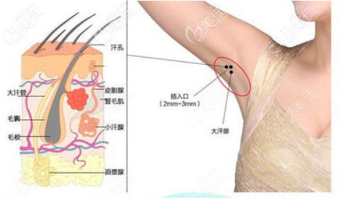 光纖治療腋臭 光纖治療腋臭