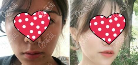 我花22000塊做的人中縮短術恢復三個月效果對比照片 我花22000塊做的人中縮短術恢復三個月效果對比照片