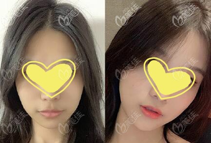 做隱痕人中縮短術恢復一年效果對比照片 做隱痕人中縮短術恢復一年效果對比照片