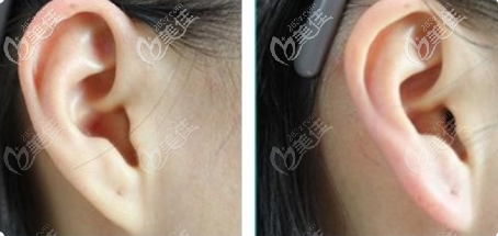 我做的玻尿酸豐耳垂的前后對比效果展示 我做的玻尿酸豐耳垂的前后對比效果展示