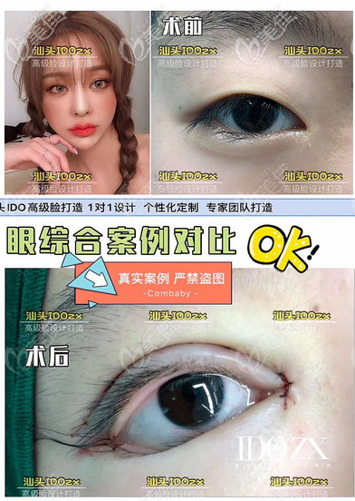 汕頭愛都滬美人雙眼皮案例