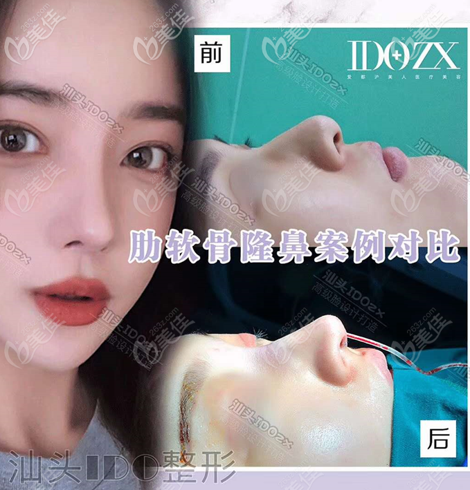 汕頭愛都滬美人張賢期醫(yī)生隆鼻案例