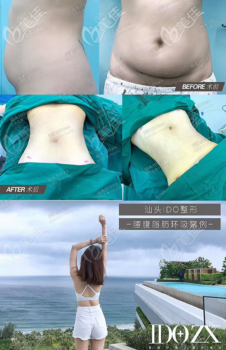 汕頭愛都滬美人張賢期醫(yī)生吸脂手術(shù)案例