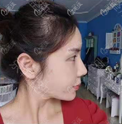 做維密6度面部脂肪填充失敗修復(fù)第8天