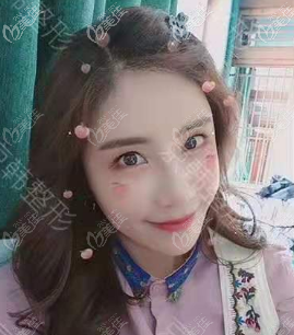 找喬愛軍做維密6度脂雕面部脂肪填充過多修復(fù)有一個多月了