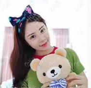 做維密6度脂雕面部修復(fù)到現(xiàn)在沒有副作用的出現(xiàn)好開心