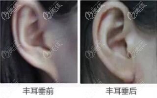 玻尿酸豐耳垂前后對比照 玻尿酸豐耳垂前后對比照