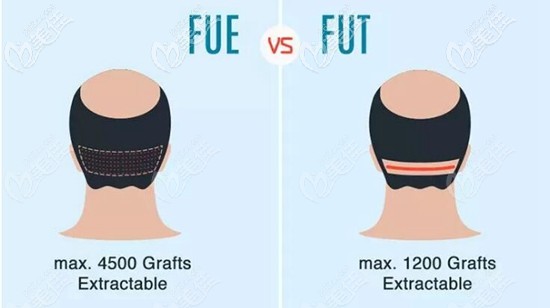 FUE和FUT植發(fā)技術(shù)效果對(duì)比