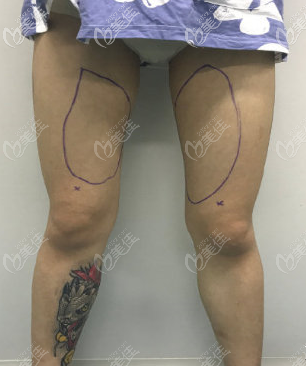 我在烏魯木齊華美吸脂前的樣子 我在烏魯木齊華美吸脂前的樣子