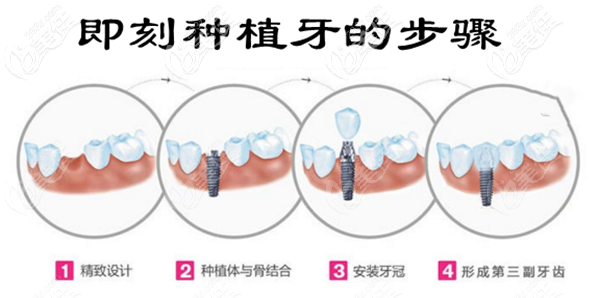 即刻種植牙當(dāng)天就能用嗎？