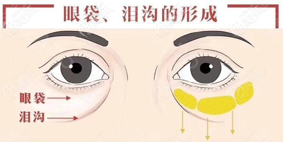眼袋和淚溝的區(qū)別圖
