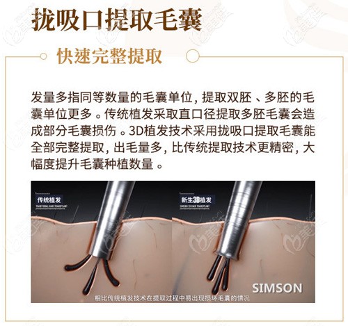 3D植發(fā)技術(shù)使用隴吸口的優(yōu)勢(shì)