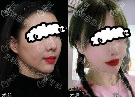 維密6度脂雕修復(fù)術(shù)后恢復(fù)三個(gè)月效果對(duì)比圖 維密6度脂雕修復(fù)術(shù)后恢復(fù)三個(gè)月效果對(duì)比圖