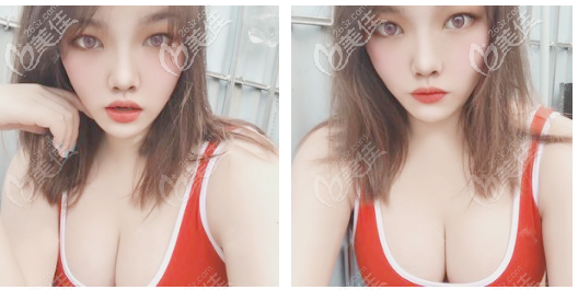 找韓妃牟北平醫(yī)生做完隆胸半年了,效果很滿意