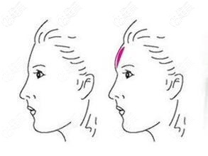 自體脂肪豐額頭效果 自體脂肪豐額頭效果