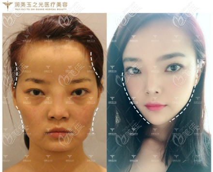 我找王明利做的面部脂肪填充案例效果