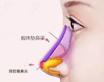 隆鼻假體墊鼻梁+耳軟骨墊鼻尖 隆鼻假體墊鼻梁+耳軟骨墊鼻尖