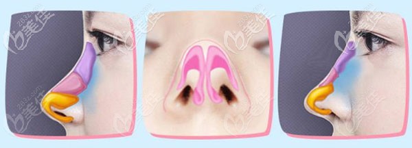 美麗星醫(yī)美做肋軟骨技術(shù)優(yōu)勢