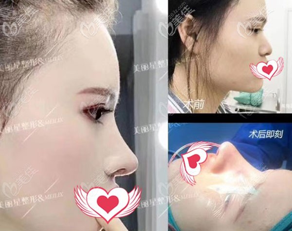 南寧美麗星整形肋軟骨隆鼻一個月的恢復(fù)<span style=