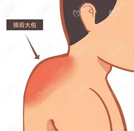 富貴包的形成原因和消除方式 富貴包的形成原因和消除方式