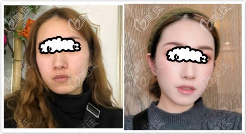 真實(shí)案例:液態(tài)熱瑪吉+普通熱瑪吉聯(lián)合做恢復(fù)三個(gè)月效果照片 真實(shí)案例:液態(tài)熱瑪吉+普通熱瑪吉聯(lián)合做恢復(fù)三個(gè)月效果照片