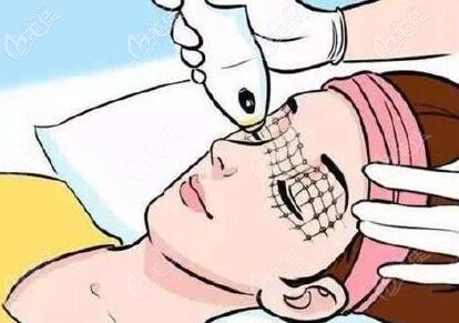 熱瑪吉面部抗衰治療方法圖解 熱瑪吉面部抗衰治療方法圖解