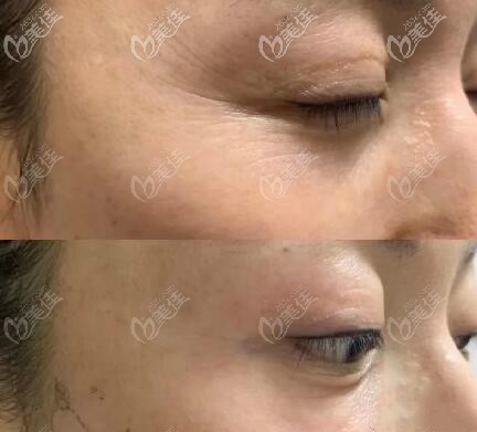 做熱瑪吉除眼部皺紋恢復(fù)一個(gè)月效果對(duì)比圖 做熱瑪吉除眼部皺紋恢復(fù)一個(gè)月效果對(duì)比圖