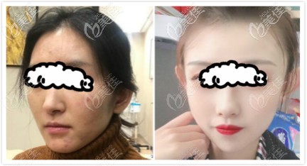 熱瑪吉全臉提升除皺效果對(duì)比圖片 熱瑪吉全臉提升除皺效果對(duì)比圖片