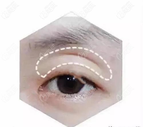 眼窩凹陷 眼窩凹陷