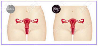 自體脂肪填充縮陰效果好嗎 自體脂肪填充縮陰效果好嗎