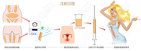 自體脂肪填充縮陰過(guò)程示意圖 自體脂肪填充縮陰過(guò)程示意圖