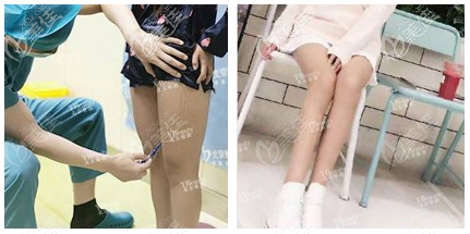 我在北京雅靚做腿部快樂吸脂術(shù)感覺國海軍技術(shù)挺好的 我在北京雅靚做腿部快樂吸脂術(shù)感覺國海軍技術(shù)挺好的